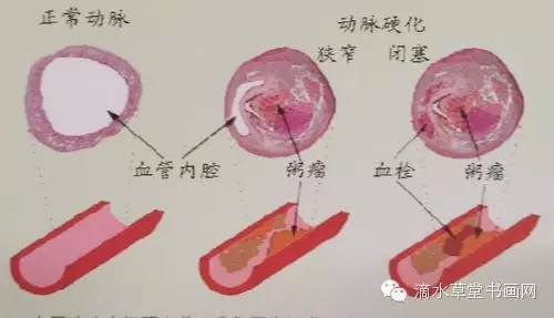 高血压的发病原因和解决2.webp.jpg